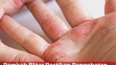 Pemkab Blitar Pastikan Pengobatan Penyakit Kusta Tidak Dipungut Biaya